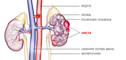 Как вылечить кисту на почках в домашних условиях Как вылечить кисту на почках в домашних условиях
