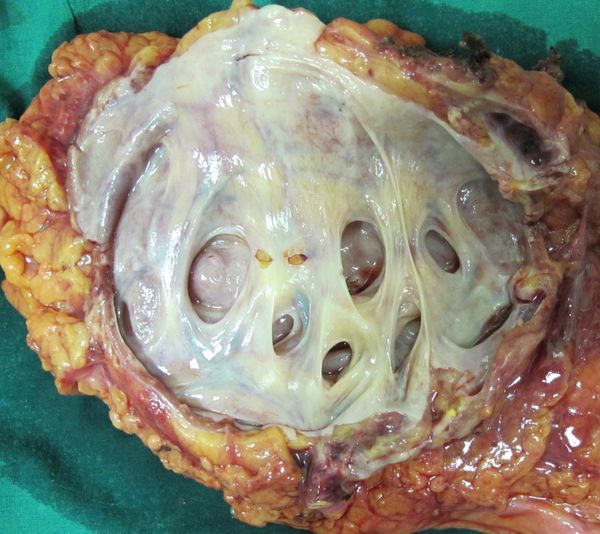 Удаленная почка.