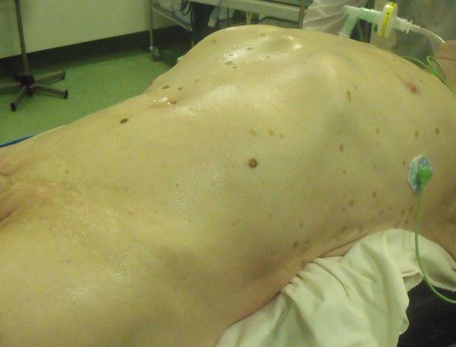 Асиметричная передняя брюшная стенка за счет опухоли левой почки