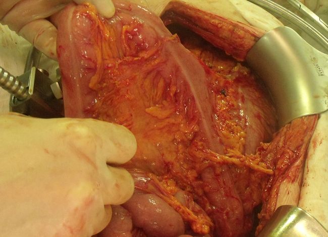 Опухоль инфильтрирует брыжейку ободочной кишки