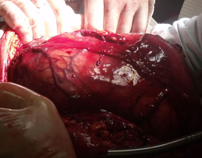 Мобилизация левой почки с опухолью