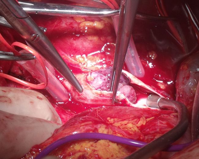 Удаление тромба из нижней полой вены