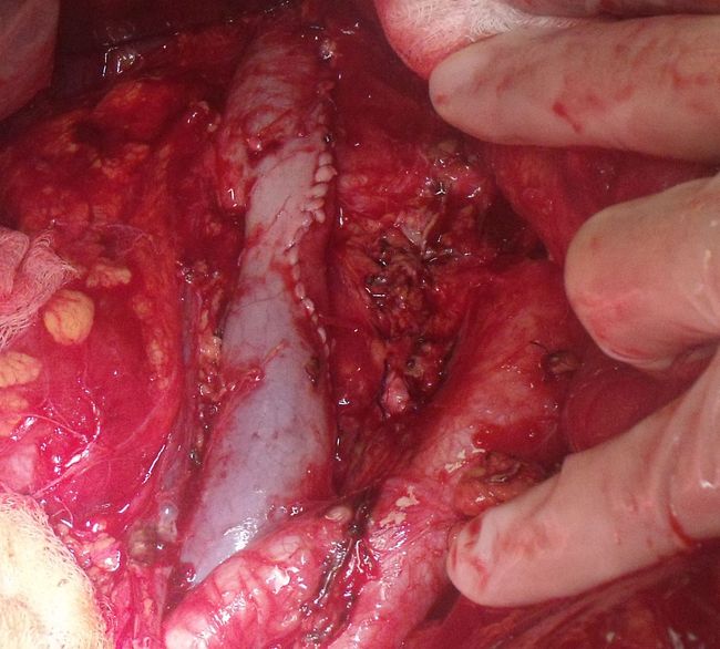 Ушитая нижняя полоя вена после каватомии и тромбэктомии