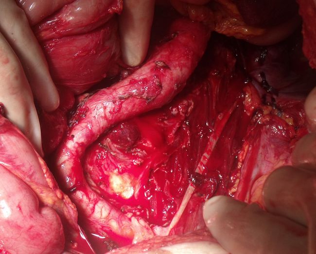 Зона парааортальной лимфодиссекции 