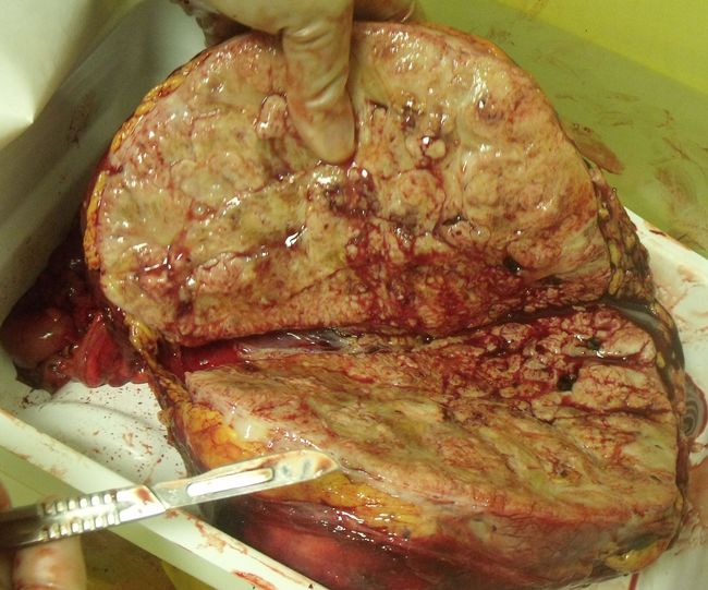 Удаленная почка, замещенная опухолью