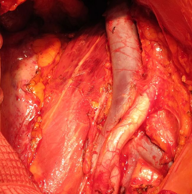 Ложе правой почки после ее удаления