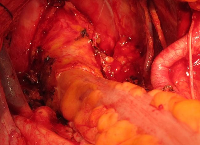 Ложе моочевого пузыря и простаты после цистпростатэктомии