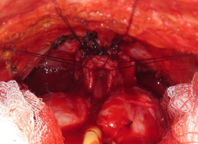 Провизорные швы на мембранозном отделе уретры