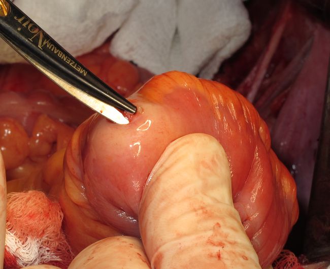 Формирование "шейки" мочевого резервуара