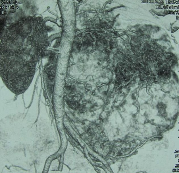 Опухоль правой почки (компьютерная томография с сосудистым контрастированием)