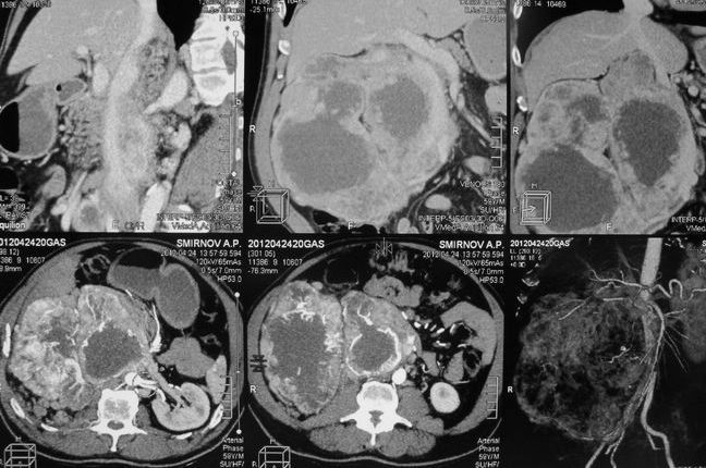 Опухоль правой почки (компьютерная томография)