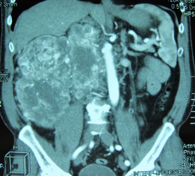 Опухоль правой почки (компьютерная томография)