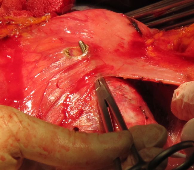 Мобилизация двенадцатиперстной кишки