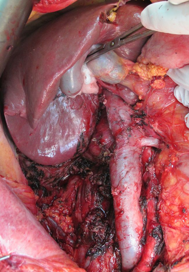 Ложе правой почки после удаления