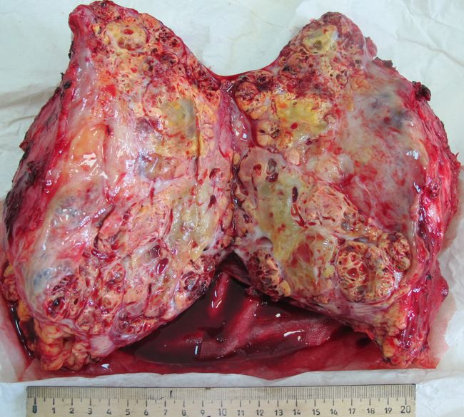 Удаленная почка с опухолью