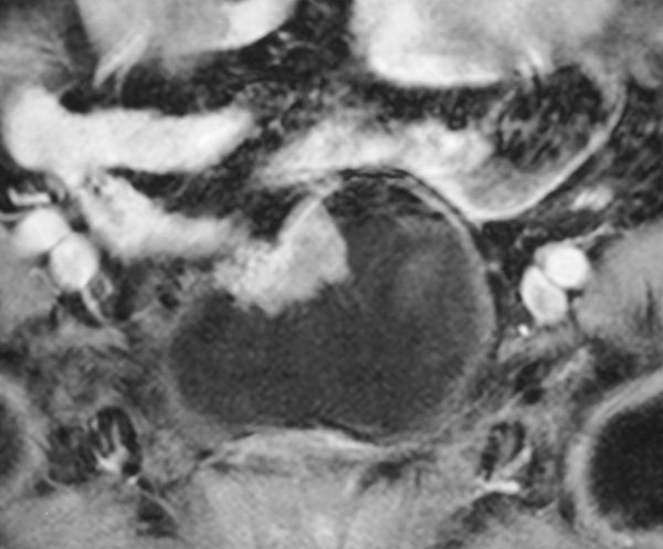 Рецидив колоретального рака в стенке мочевогопузыря