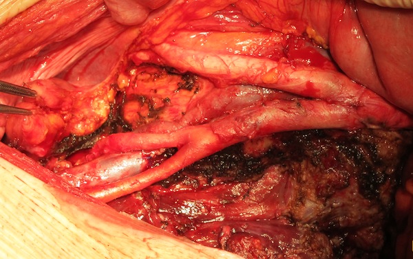 Вид операционной раны после удаления опухоли с краевой резекцией левой общей подвздошной вены. Скелетированные аорта и подвздошные сосуды.