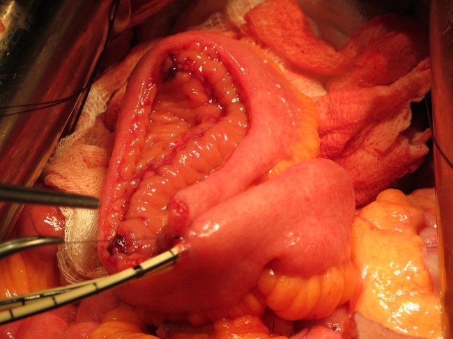 Формирование ортотопического  мочевого J-резервуара