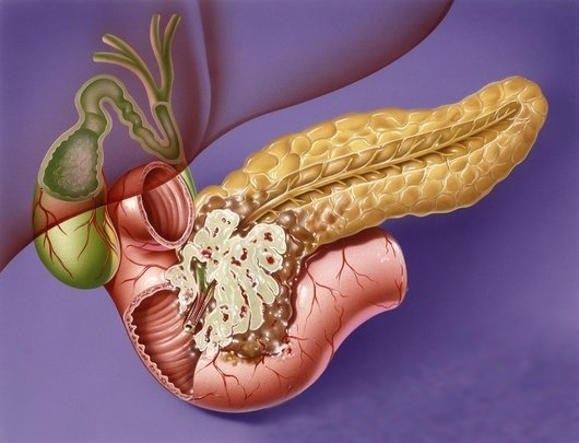 Алт при раке поджелудочной железы