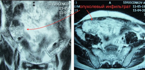 Рецидив рака слепой кишки
