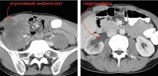 Рецидив рака слепой кишки