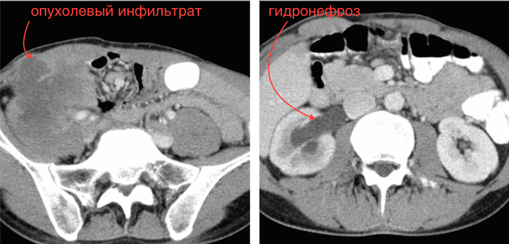 Инфильтрат малого таза. Опухолевый инфильтрат в Малом тазу. Опухолевый инфильтрат брюшной полости у детей. Рецидивы опухолей кишки фото. Рецидив рака 1 стадии