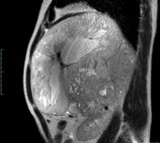 Гастроинтестинальная стромальная опухоль гигантских размеров, исходящая из большой кривизны желудка