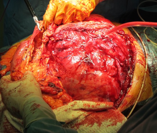 Обнаженная опухоль