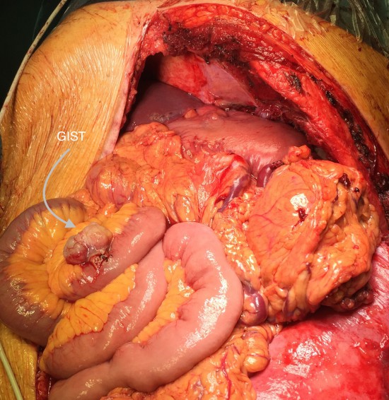 После удаления основного опухолевого очага. Второй очаг на тонкой кишке.