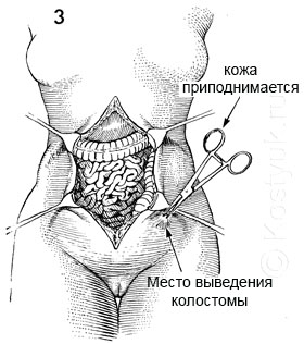 Схема операция гартмана