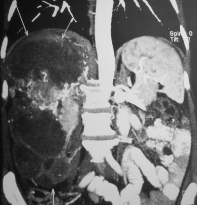 КТ органов брюшной полости.
