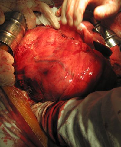 Мобилизация почки