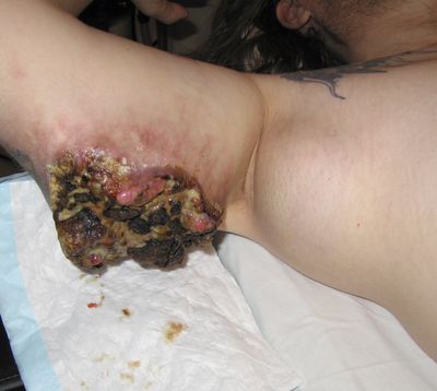 Рецидив меланомы на задней поверхности правого плеча