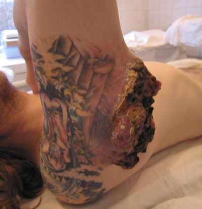 Рецидив меланомы задней поверхности правого плеча