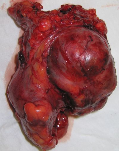 Удаленный конгрламерат метастически измененных лимфатических узлов