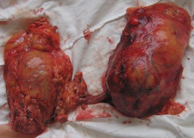 Моноблочно удаленные мочевой пузырь и левая почка, пораженные опухолью