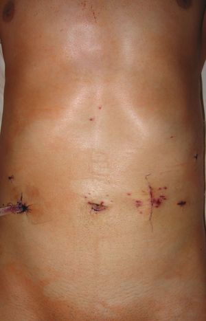 После удаления желудка