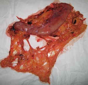 Удаленный желудок