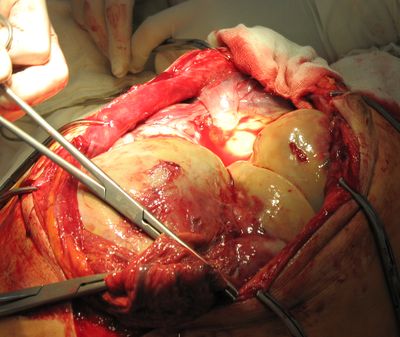 Опухоль выполняет всю брюшную полость