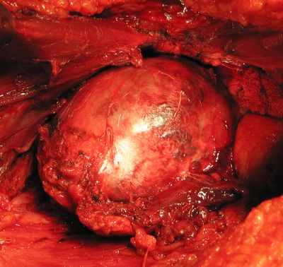 Мобилизованная опухоль