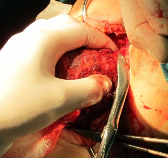 Резекция 11 и 12 ребер, инфильтрируемых опухолью.