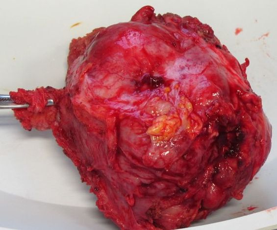 Удаленная опухоль.
