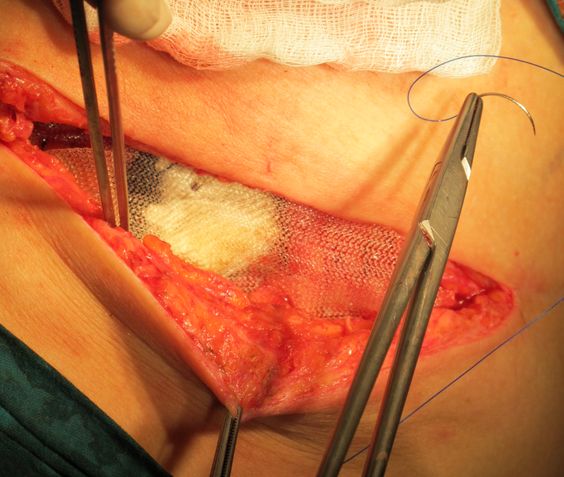 Пластика дефекта брюшной стенки проленовой сеткой.